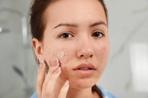 Menina adolescente aplicando acne cura patch dentro de casa, close-up — Fotografia de Stock