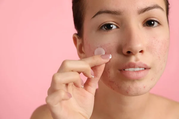 Teen girl applying acne healing patch on light pink background — Stock Photo, Image