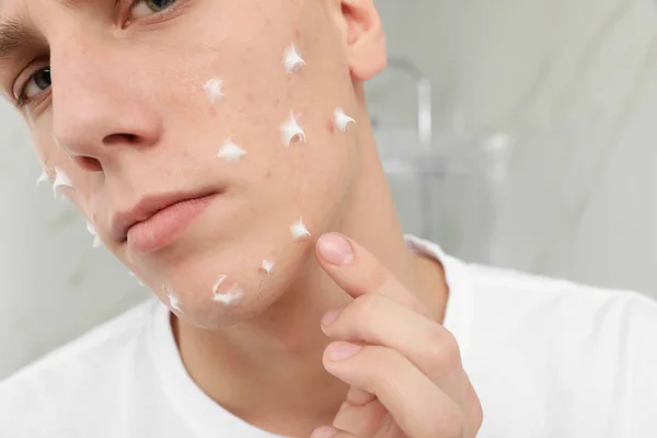 Adolescente cara com acne problema aplicando creme dentro de casa, close-up — Fotografia de Stock