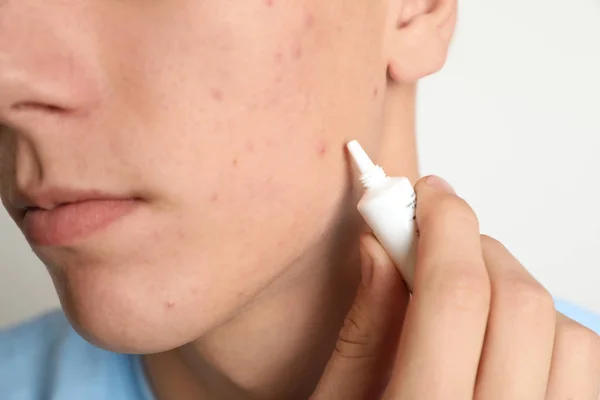 Teen guy with acne problem applying cream on light background, c — Stock Photo, Image