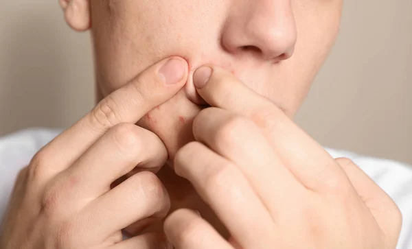 Teen guy with acne problem squeezing pimple on beige background, — Stock Photo, Image