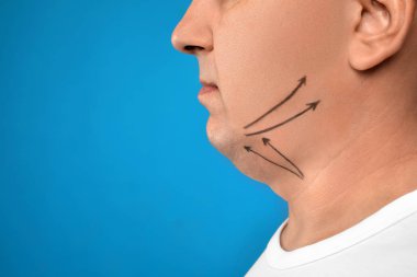 Mature man with marks on face against blue background, closeup.  clipart