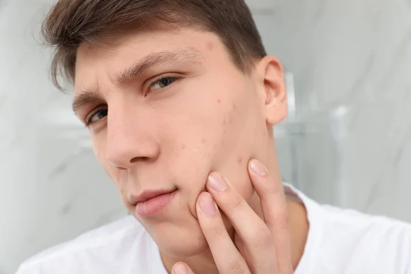 Adolescente cara com acne problema dentro de casa, close-up — Fotografia de Stock