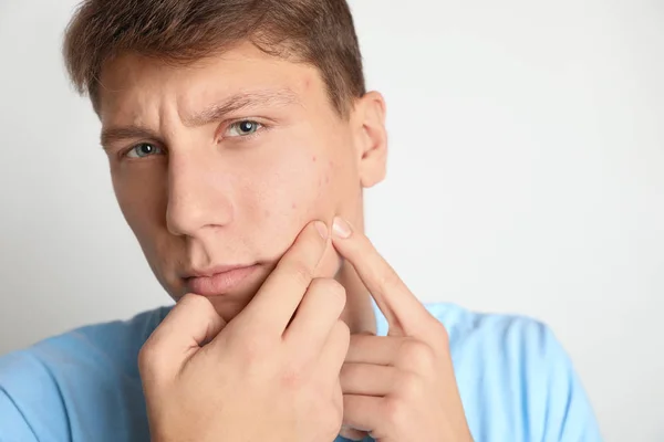 Adolescente cara com problema de acne espremendo espinha no fundo claro — Fotografia de Stock