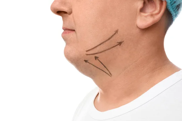 Mature man with marks on face against white background, closeup. — Stock Photo, Image