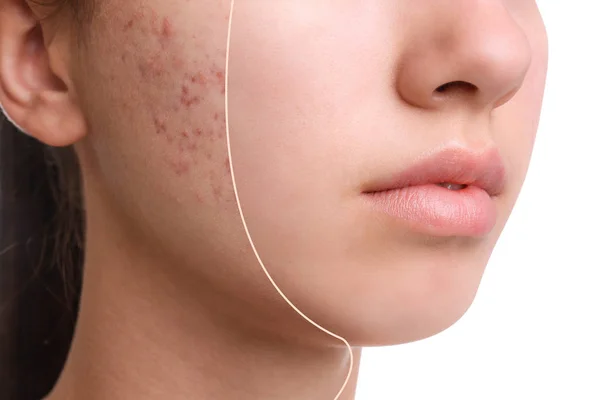 Adolescente com problema de acne no fundo branco, close-up — Fotografia de Stock