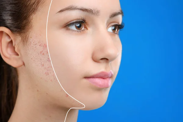 Tiener meisje met acne probleem op blauwe achtergrond, close-up — Stockfoto