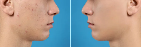 Teenager Acne Treatment Blue Background Closeup — Stock Photo, Image