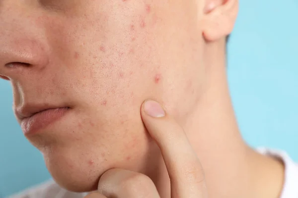Teen guy with acne problem on light blue background, closeup — Stock Photo, Image