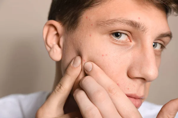 Tonårskille med akne problem klämma finne på beige bakgrund, — Stockfoto