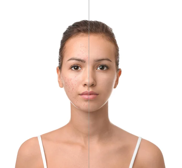 Tiener meisje met acne probleem op witte achtergrond — Stockfoto