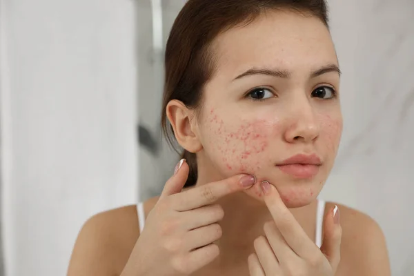 Teen girl with acne problem squeezing pimple indoors