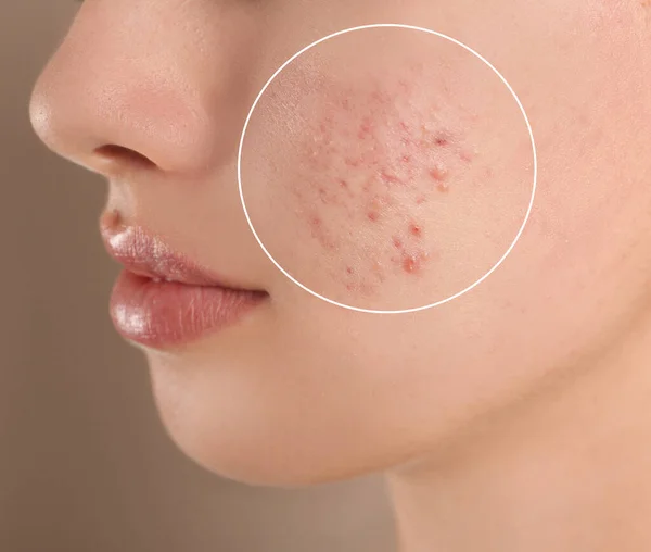 Teenage girl with acne problem on beige background, closeup — Stock Photo, Image