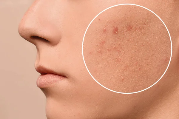 Adolescente cara com problema de acne no fundo bege, close-up — Fotografia de Stock