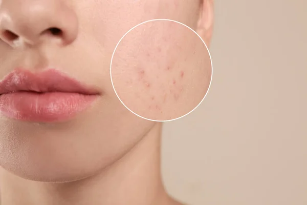 Adolescente com problema de acne no fundo bege, close-up — Fotografia de Stock