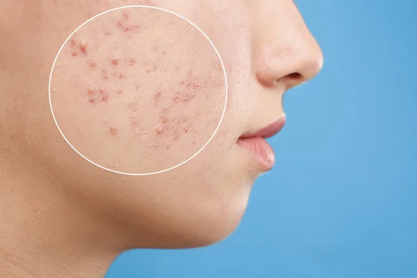 Teenage girl with acne problem on blue background, closeup — Stock Photo, Image