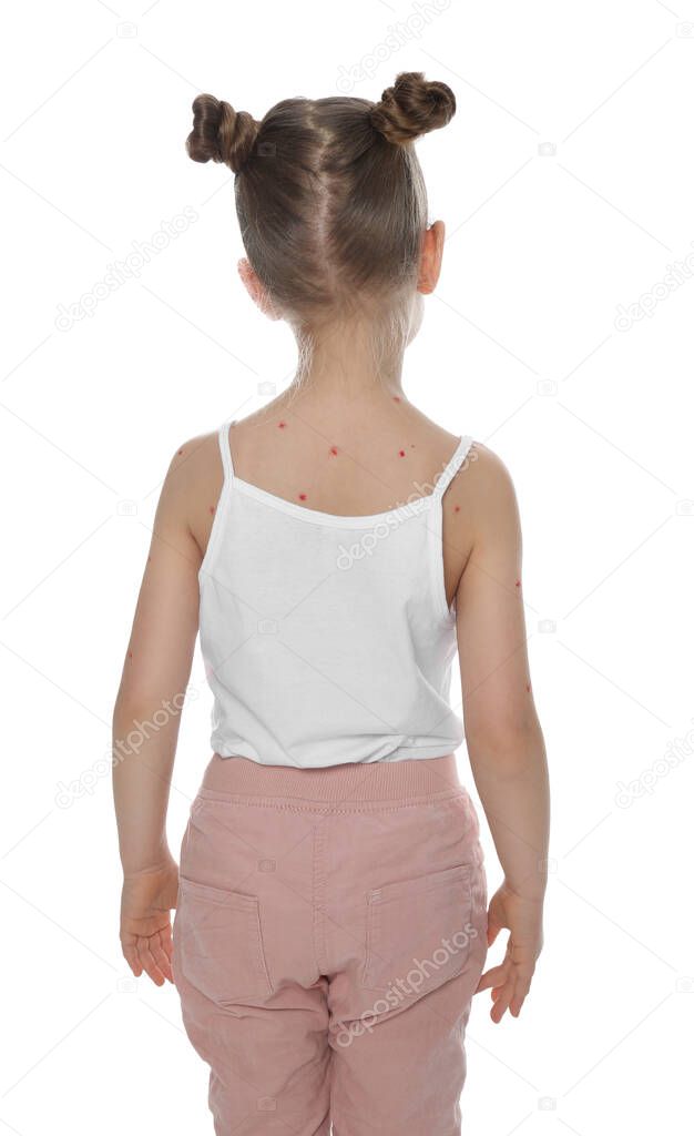 Little girl with chickenpox on white background. Varicella zoster virus