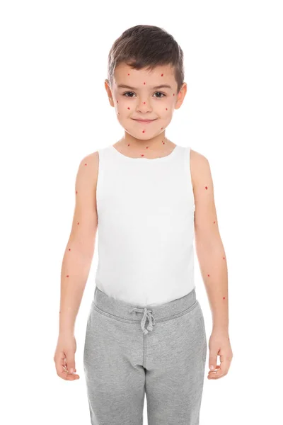 Mały Chłopiec Ospą Wietrzną Białym Tle — Zdjęcie stockowe