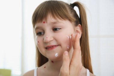 Evde suçiçeği olan küçük bir kızın cildine krem süren bir kadın.