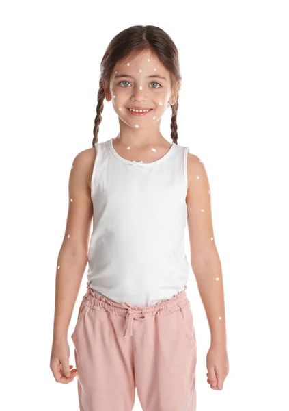 Mała Dziewczynka Ospą Wietrzną Białym Tle — Zdjęcie stockowe