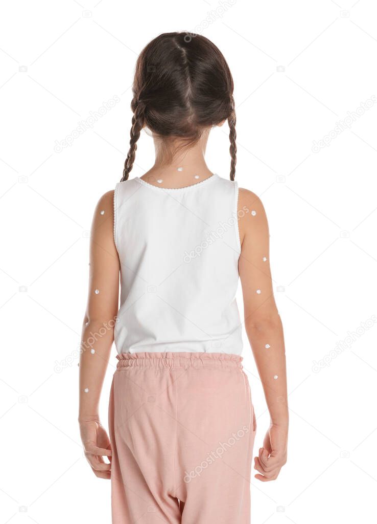 Little girl with chickenpox on white background, back view