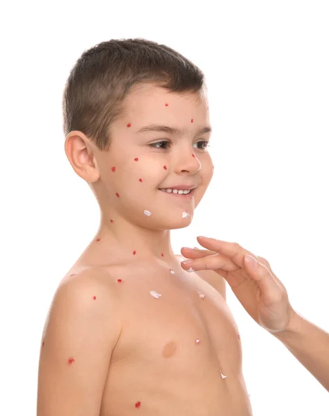 Mujer Aplicando Crema Sobre Piel Niño Con Varicela Sobre Fondo —  Fotos de Stock