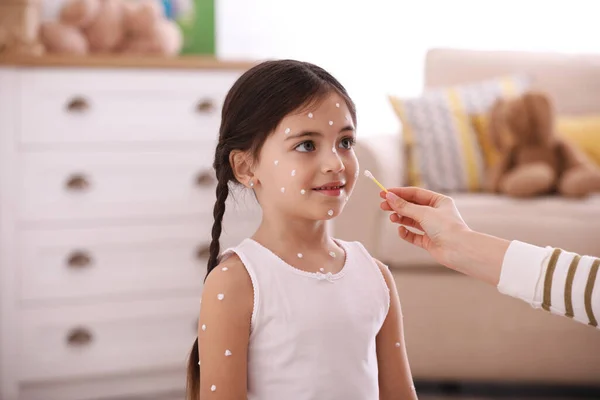 Mother Applying Cream Skin Her Daughter Chickenpox Home — Stock Photo, Image