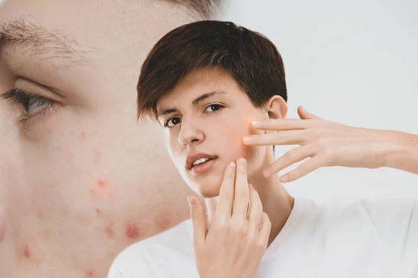 恐怖症に苦しむ10代の少年が顔を調べる 問題のある肌の人のビジョン — ストック写真