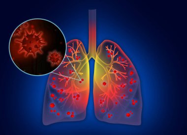 Mavi arka planda hastalıktan etkilenen insan akciğerleri tasviri