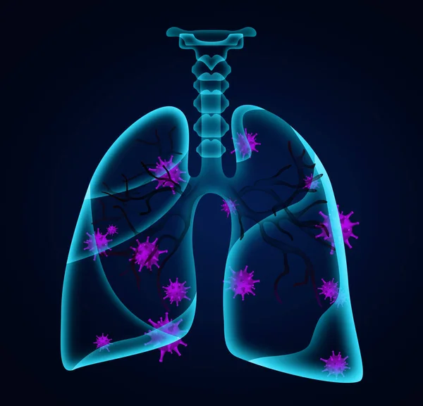 Ilustracja Ludzkich Płuc Dotkniętych Chorobą Ciemnym Tle — Zdjęcie stockowe