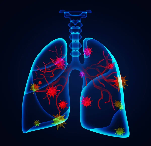 Illustration Human Lungs Affected Disease Dark Background — Stock Photo, Image