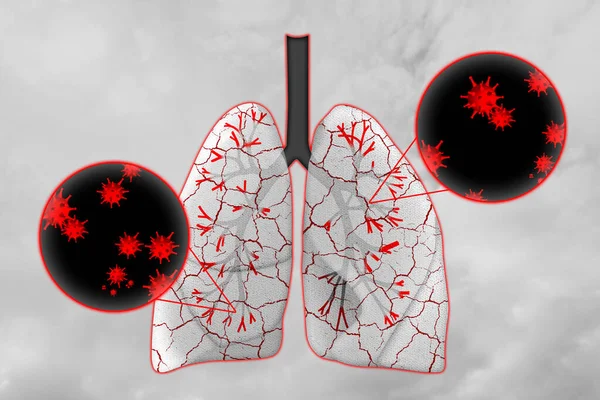 浅层背景下感染疾病的人类肺图解 — 图库照片
