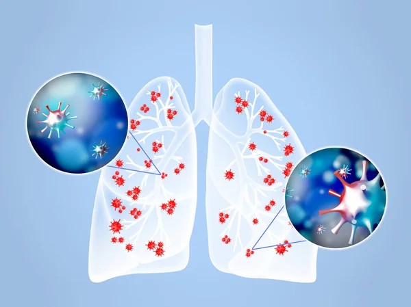 Ilustración Los Pulmones Humanos Afectados Con Enfermedad Sobre Fondo Azul — Foto de Stock