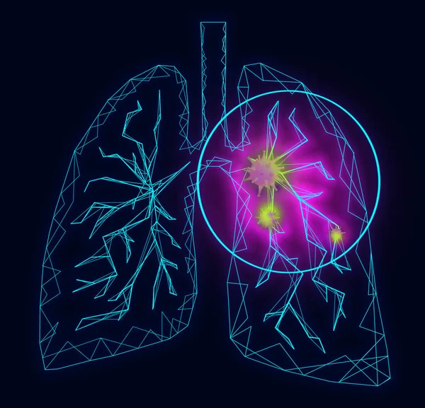 Illustration Human Lungs Affected Disease Dark Background — Stock Photo, Image