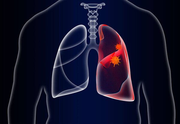 Человек с больными легкими на тёмном фоне. Иллюстрация
