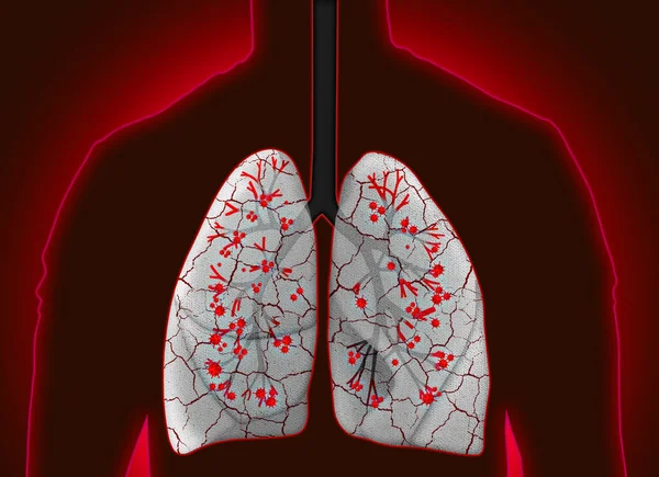赤い背景に病気の肺を持つ男 イラスト — ストック写真