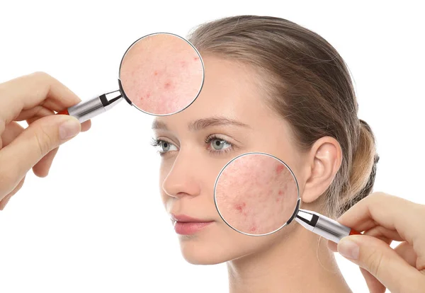 Young Woman Acne Problem Visiting Dermatologist Closeup Skin Magnifying Glass — Stock Photo, Image