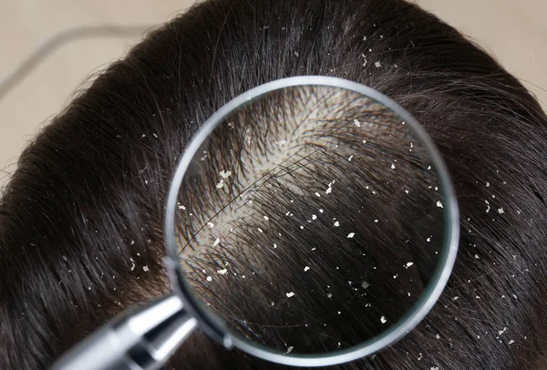 Mulher Com Caspa Cabelo Perto Vista Através Lupa — Fotografia de Stock