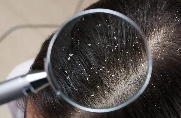 Nahaufnahme Einer Frau Mit Schuppen Haar Blick Durch Vergrößerungsglas — Stockfoto