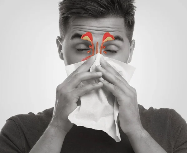 Mann Leidet Schnupfen Als Allergie Symptom Nasennebenhöhlen Illustration Gesicht — Stockfoto