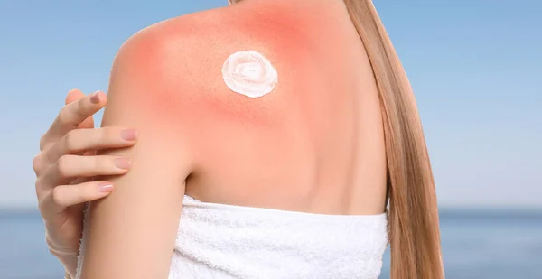 Mujer Con Quemaduras Sol Cerca Del Mar Primer Plano Protección — Foto de Stock