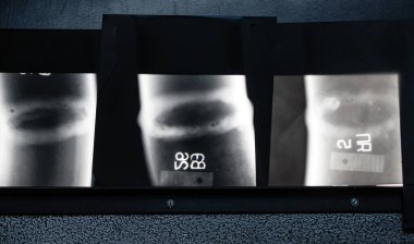 Dahili eklentiler olmadan kaynaklama dikişinin X-ray görüntüsü