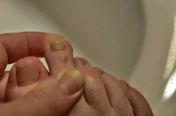 Close-up image of a fingernail on the right foot of a Caucasian — Stock Photo, Image