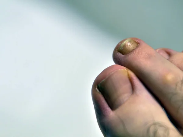 Крупным планом изображение ногтя на правой ноге кавказца — стоковое фото