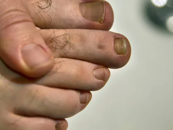 Close-up image of a fingernail on the right foot of a Caucasian — Stock Photo, Image