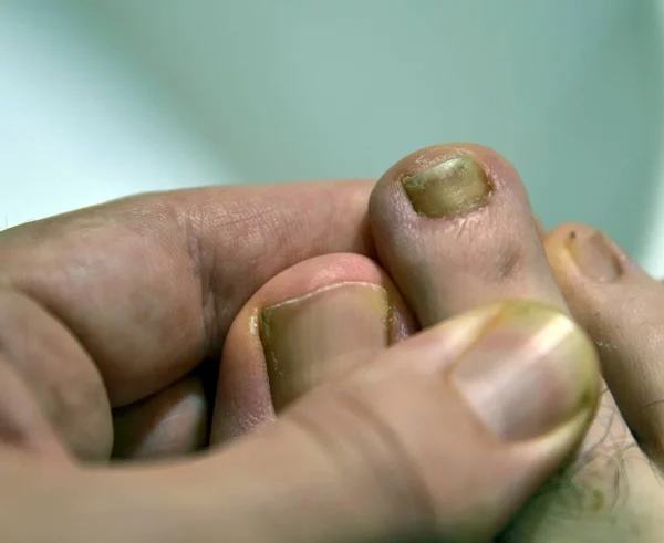 Imagem de close-up de uma unha no pé direito de um caucasiano — Fotografia de Stock