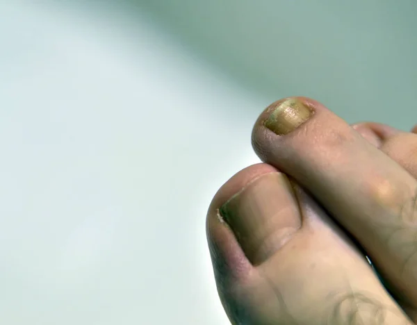 Detailní záběr nehtu na pravé noze bělocha — Stock fotografie