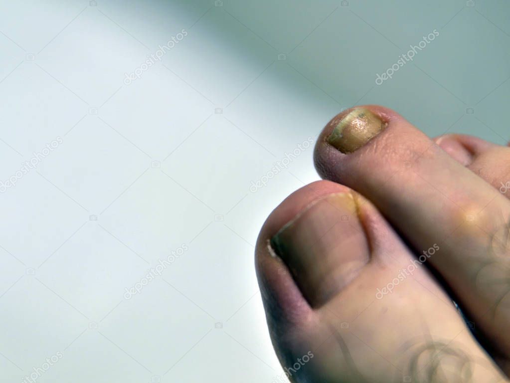 Close-up image of a fingernail on the right foot of a Caucasian 