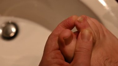 Beyaz bir adamın sağ ayağında bir tırnağın yakın plan görüntüsü. Baş parmağın yanındaki tırnağın üzerinde mikoz belirtileri görülüyor.. 