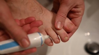 Beyaz bir adamın sağ ayağında bir tırnağın yakın plan görüntüsü. Baş parmağın yanındaki tırnağın üzerinde mikoz belirtileri görülüyor.. 